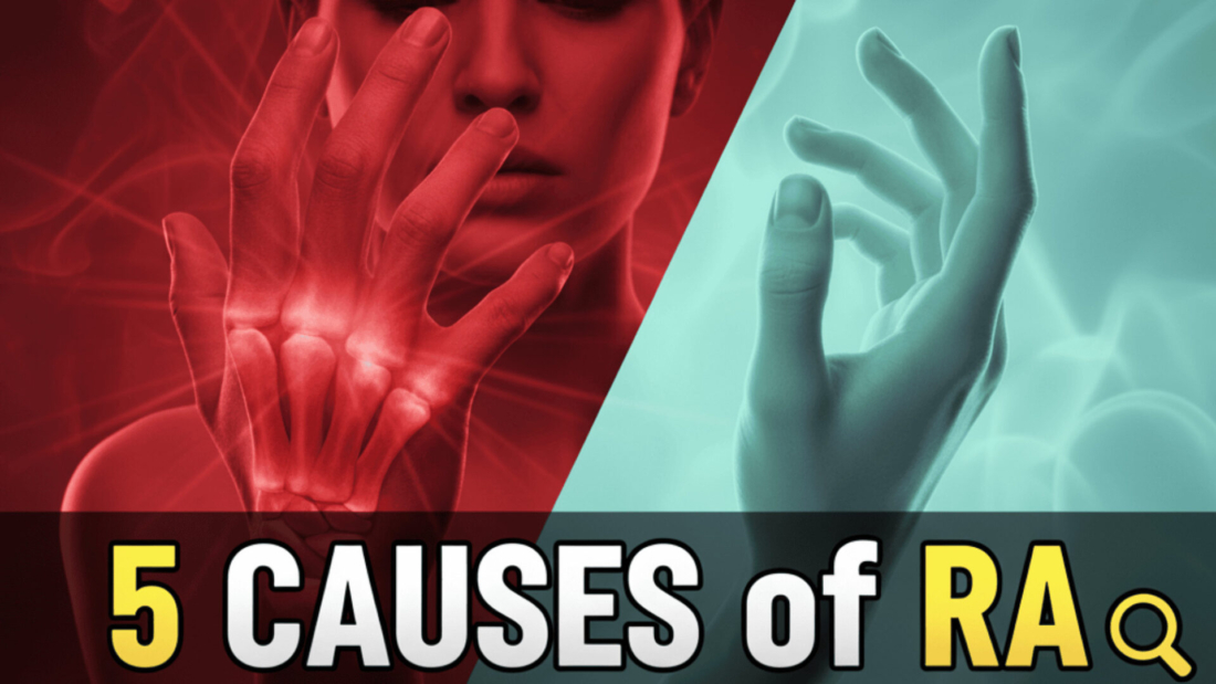 Rheumatoid Arthritis