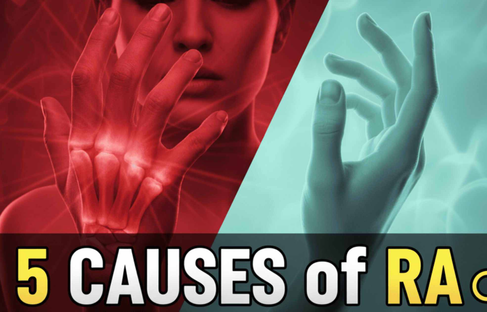 Rheumatoid Arthritis