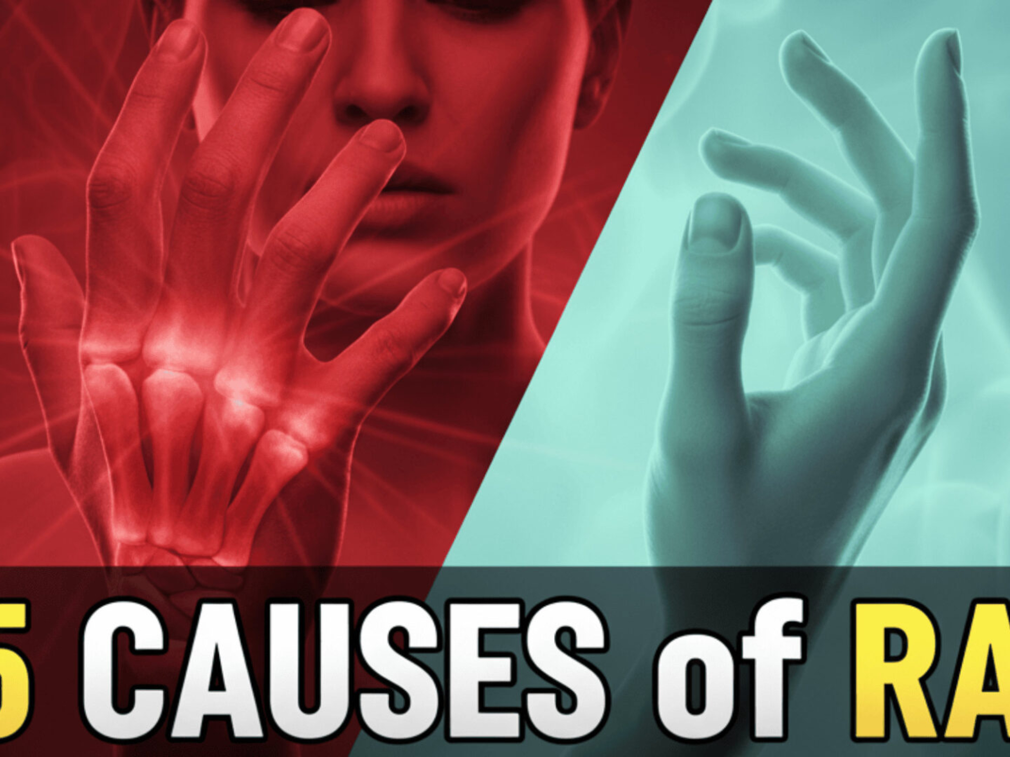 Rheumatoid Arthritis