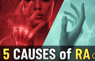 Rheumatoid Arthritis