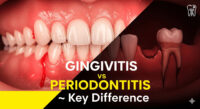 gingivitis vs periodontitis
